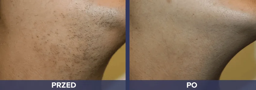 Depilacja Vectus - broda