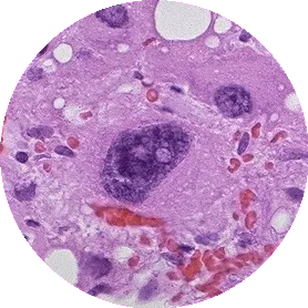 Cytomegalia