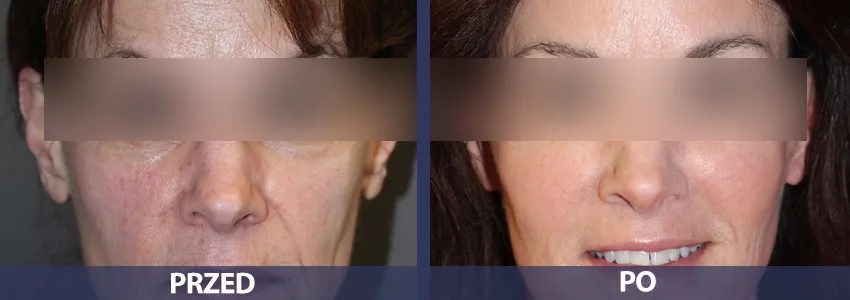 Dermapen - przed i po