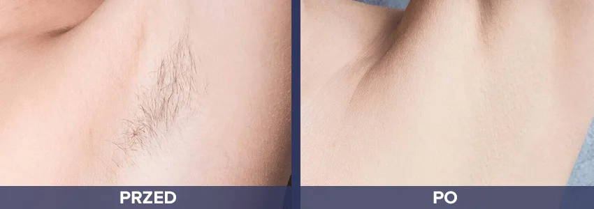 Depilacja Vectus - pachy