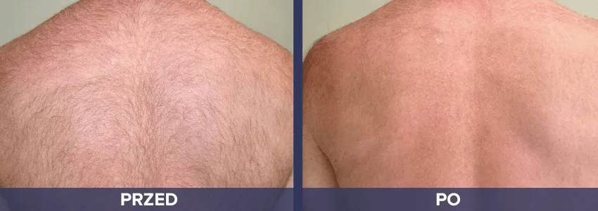 Depilacja Vectus - plecy