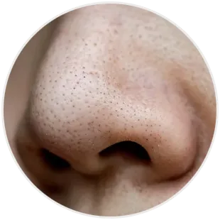 Wągry na nosie
